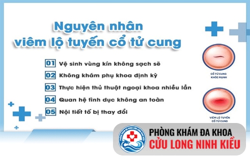 Nguyên nhân viêm lộ tuyến cổ tử cung