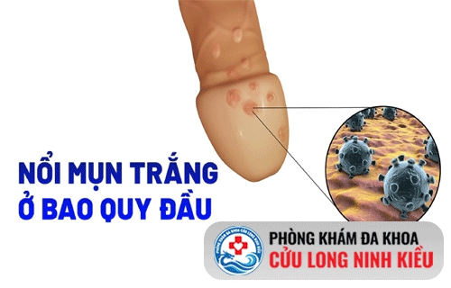 Nổi mụn trắng ở bao quy đầu là bệnh gì?
