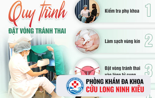 Cách đặt vòng tránh thai an toàn cho phụ nữ
