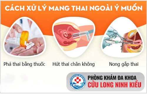 Phá thai ngoài ý muốn
