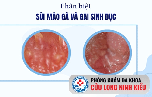 Phân biệt gai sinh dục với sùi mào gà