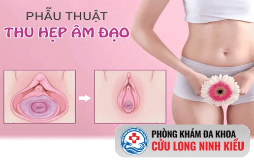 Thủ thuật thu hẹp âm đạo