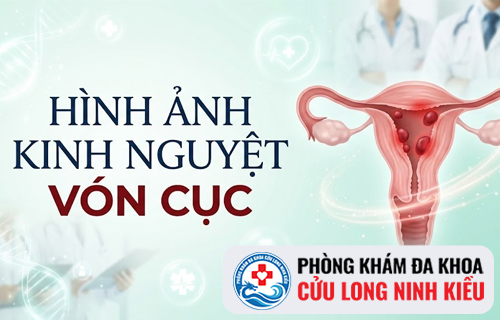 Kinh nguyệt vón cục là bị bệnh gì?