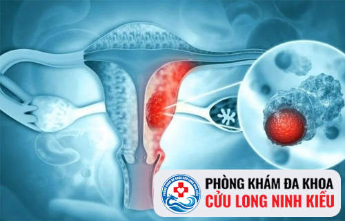 Lạc nội mạc tử cung bệnh nguy hiểm không lường
