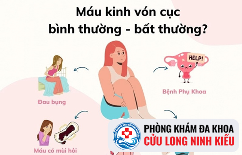 Máu kinh vón cục là bị gì?