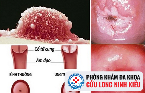 Nổi mụn ở tử cung là dấu hiệu của bệnh gì ?
