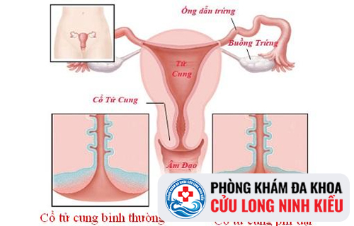 Những nguyên nhân gây phì đại cổ tử cung ở nữ giới