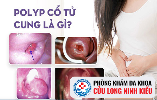 Cách điều trị Polyp tử cung