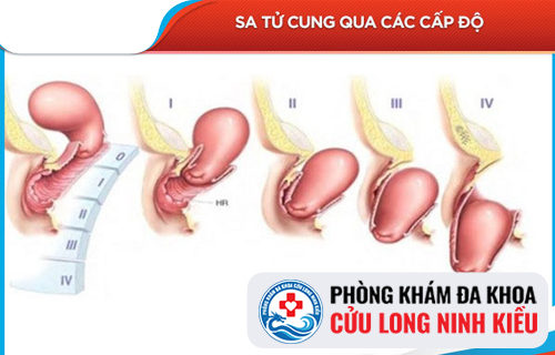Địa chỉ điều trị bệnh sa tử cung ở nữ giới