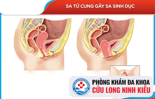 Những nguyên nhân gây sa tử cung ở nữ giới