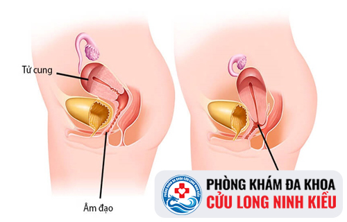 Sa tử cung có những triệu chứng như thế nào?
