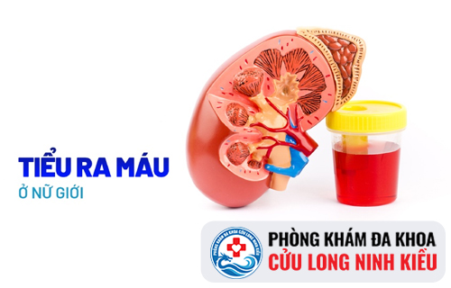 Đi tiểu ra máu ở nữ giới là dấu hiệu cảnh báo bệnh gì?
