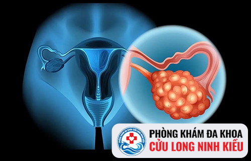 Phương pháp điều trị u nang buồng trứng hiệu quả