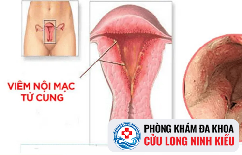 Một Số Kiến Thức Về Viêm Nội Mạc Tử Cung Bạn Cần Biết