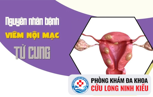 Những điều chị em cần biết về viêm nội mạc tử cung