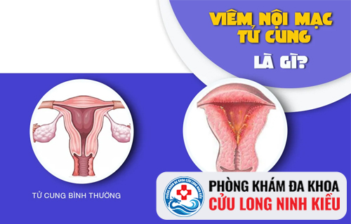 Những điều cần biết về bệnh viêm nội mạc tử cung ở nữ giới