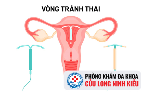 Đặt vòng tránh thai an toàn tại Phòng Khám Đa Khoa Cửu Long Ninh Kiều