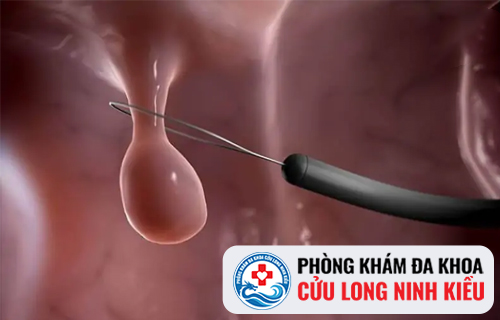 Đốt Polyp cổ tử cung hiệu quả tại Phòng Khám Đa Khoa Cửu Long Ninh Kiều
