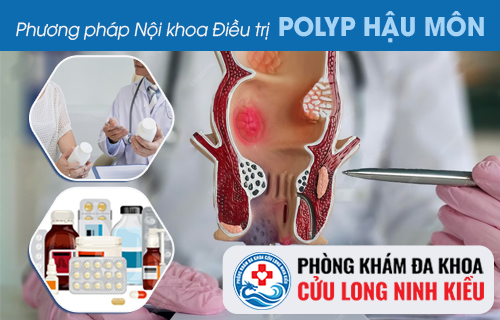 Phương pháp hỗ trợ điều trị Polyp hậu môn hiệu quả