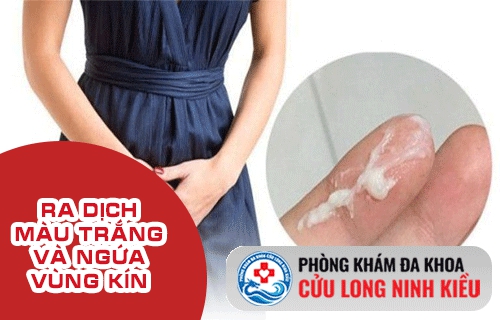 Ra dịch màu trắng và ngứa vùng kín