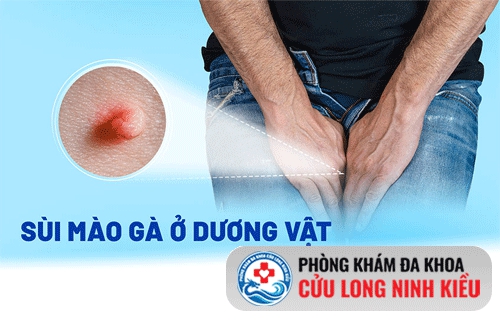 sùi mào gà ở thân dương vật - những nguy hại tiềm ẩn