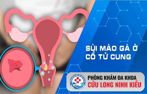 Một Số Dấu Hiệu Và Hình Ảnh sùi mào gà Ở Tử Cung