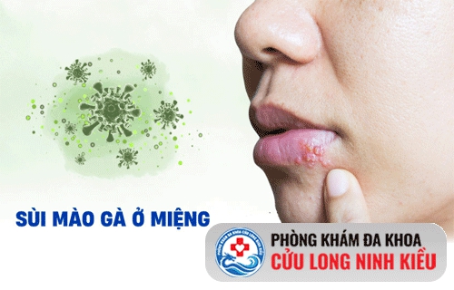 sùi mào gà ở miệng