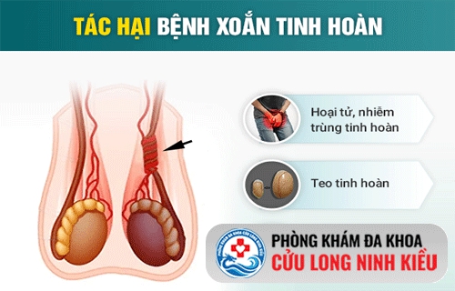Xoắn tinh hoàn – “lơ là” sẽ mất “bi”