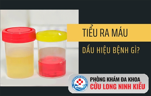 Tìm hiểu hiện tượng tiểu ra máu ở nam và nữ giới