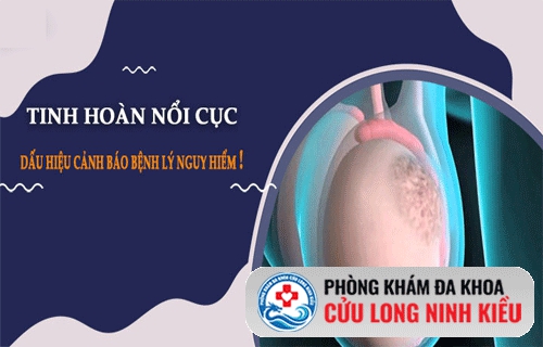 Vì sao tinh hoàn nổi hạch?
