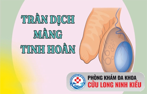 Tràn dịch màn tinh hoàn – bệnh không nên “lơ là”