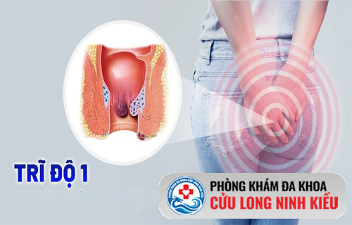 Nhận biết bệnh trĩ cấp độ 1 qua những dấu hiệu âm thầm ít ai để ý