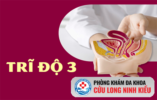Bệnh trĩ cấp độ 3 với những dấu hiệu điển hình bạn không nên bỏ qua