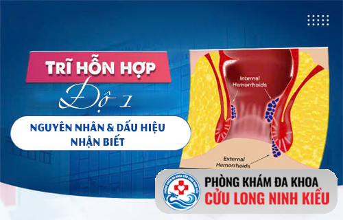Chủ quan với trĩ hỗn hợp độ 1 – Hậu quả không ngờ tới
