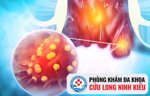Biểu Hiện Của Bệnh Trĩ Ngoại Thường Gặp