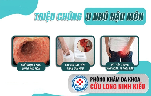 Nổi cục u ở hậu môn là bệnh gì và cách hỗ trợ chữa như thế nào?