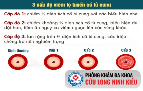 Viêm lộ tuyến cổ tử cung độ 1, 2, 3
