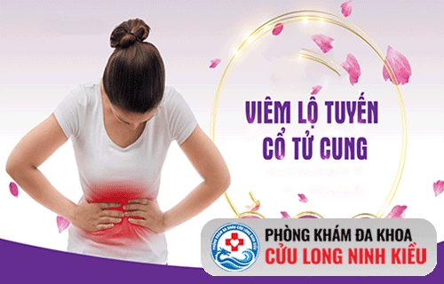 Viêm lộ tuyến cổ tử cung là bệnh gì?