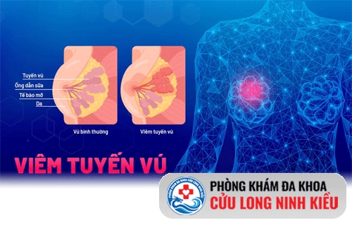 Viêm tuyến vú gây ra nhiều nguy cơ