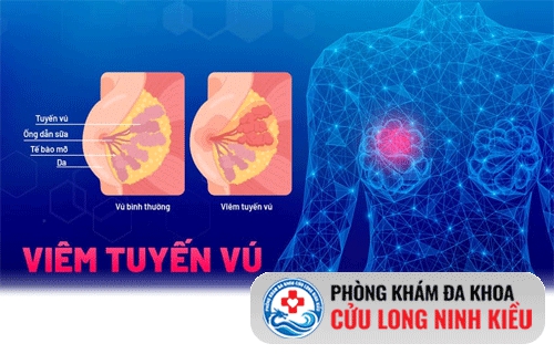 Khắc phục tình trạng viêm tuyến vú